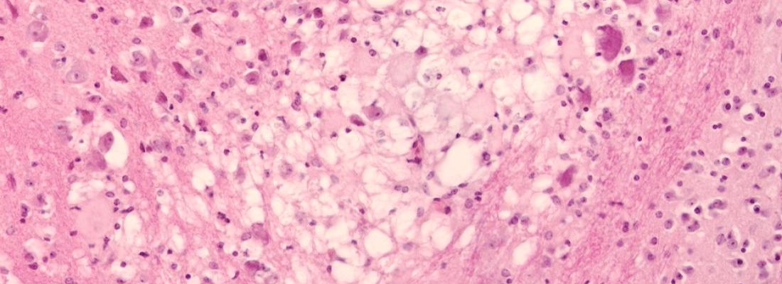 illustration L’origine de l’encéphalopathie spongiforme bovine identifiée ?